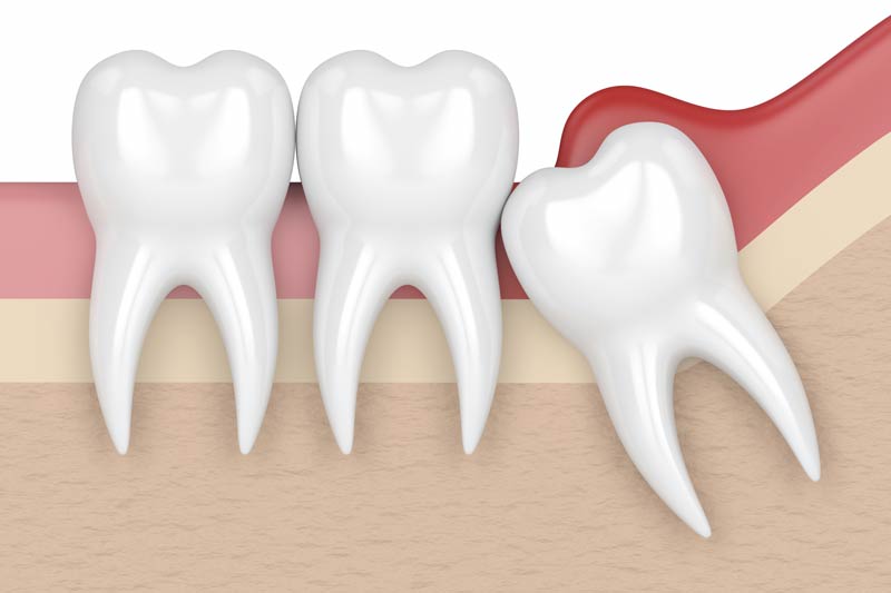 Sinus Augmentation in Spring